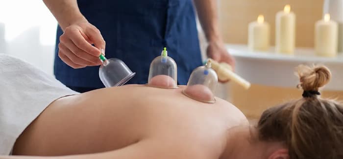 Cupping Therapy